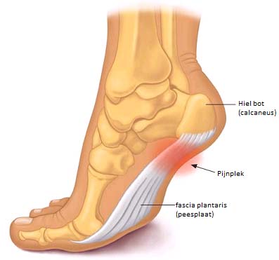 Blessure: Fasciitis Plantaris
